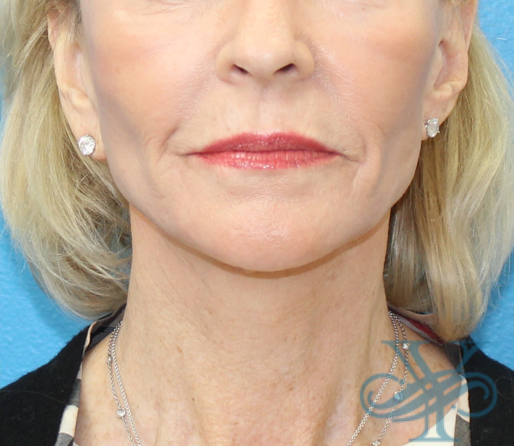 After facelift necklift Dr. Yegiyants, Santa Barbara, Ca