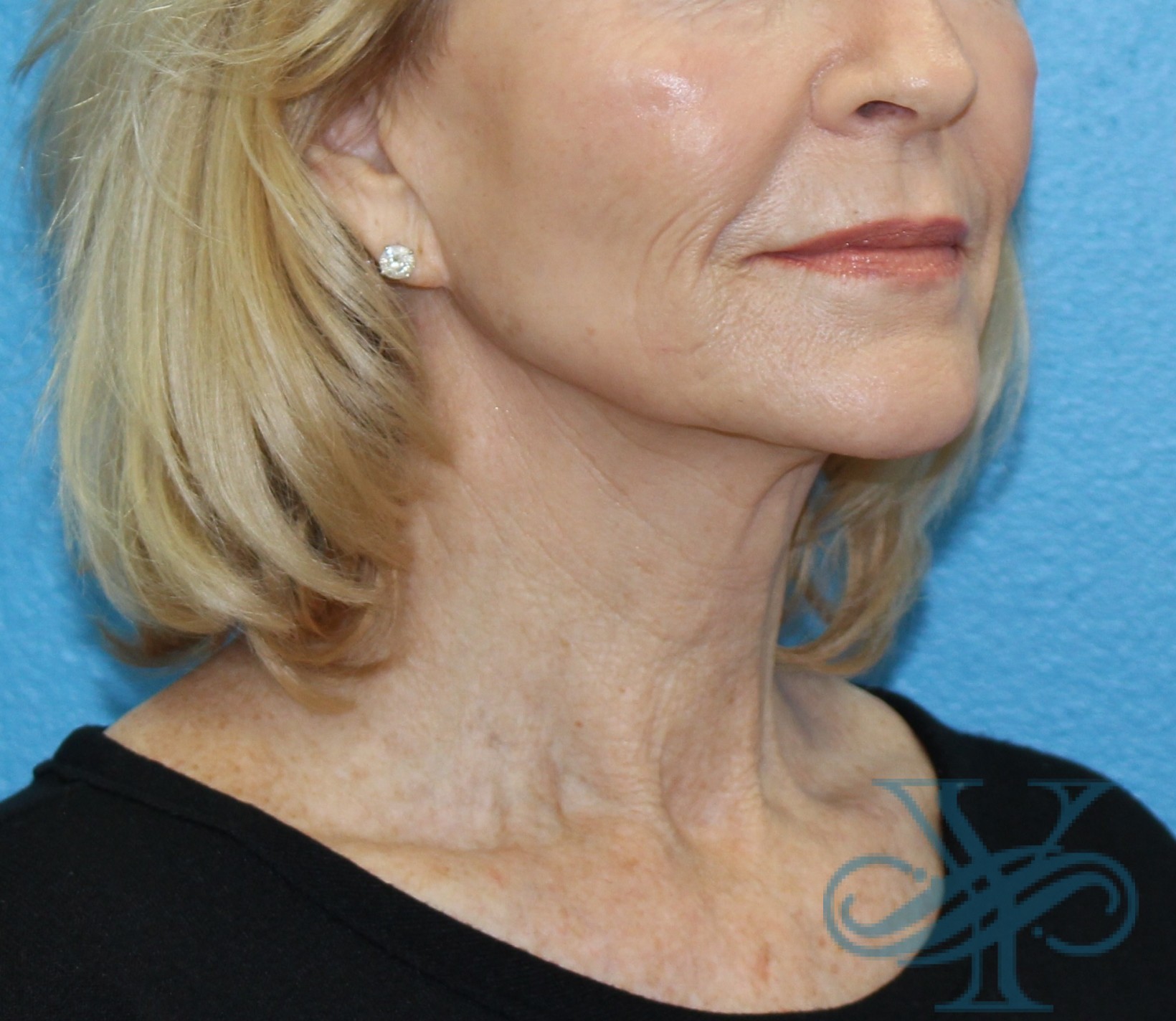 Before facelift and necklift Dr. Yegiyants, Santa Barbara, CA