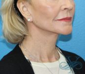 After facelift necklift Dr. Yegiyants, Santa Barbara, Ca