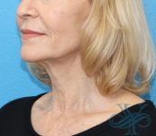 Before facelift and necklift Dr. Yegiyants, Santa Barbara, CA