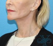 After facelift necklift Dr. Yegiyants, Santa Barbara, Ca