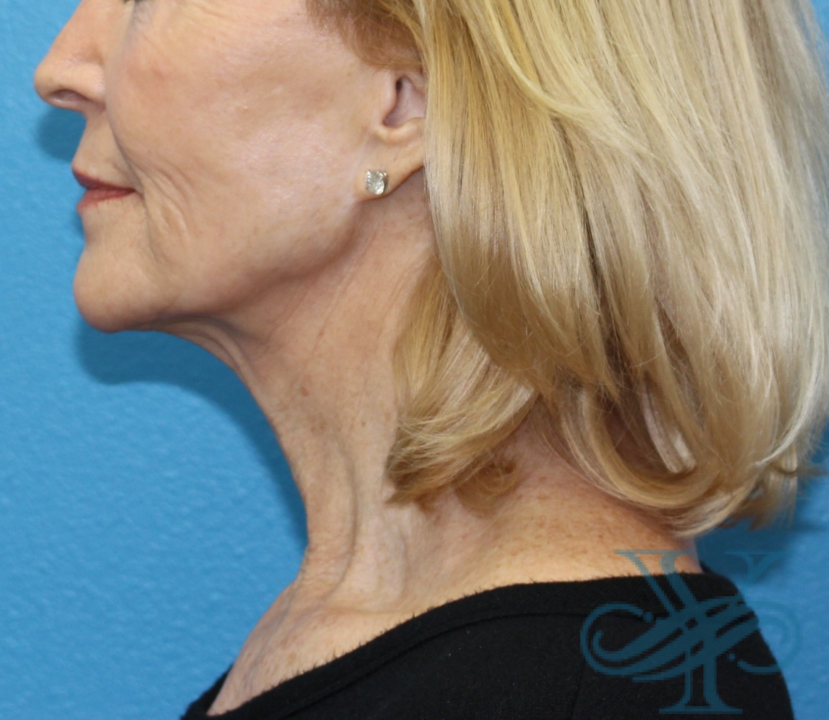 Before facelift necklift Dr. Yegiyants, Santa Barbara, Ca