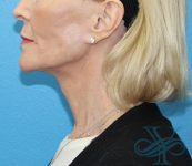 After facelift necklift Dr. Yegiyants, Santa Barbara, Ca