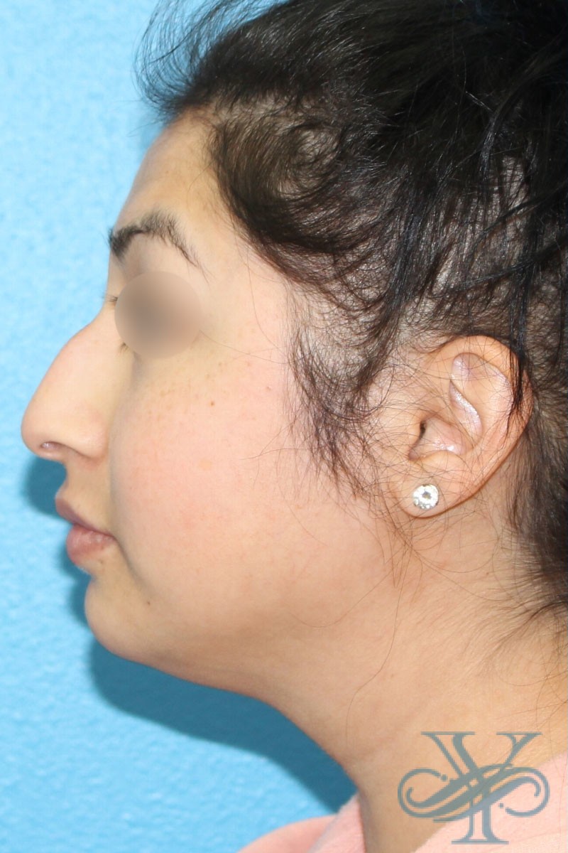 After filler Dr. Yegiyants, Santa Barbara, CA