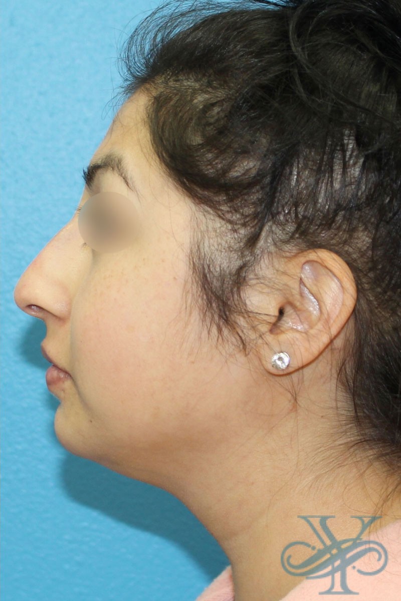 Before filler Dr. Yegiyants, Santa Barbara, CA
