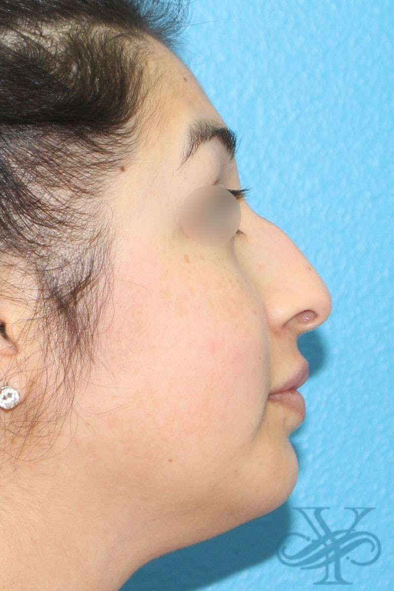 Before filler Dr. Yegiyants, Santa Barbara, CA