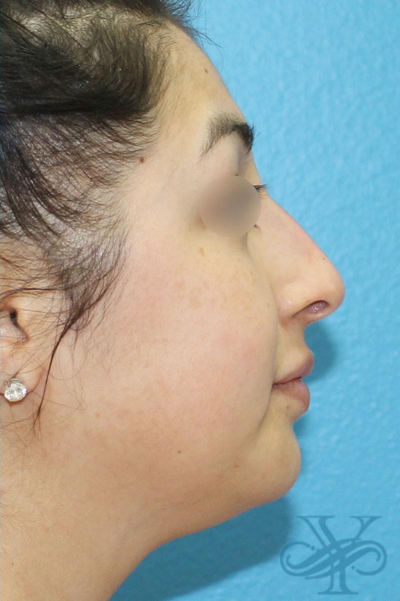 After filler Dr. Yegiyants, Santa Barbara, CA