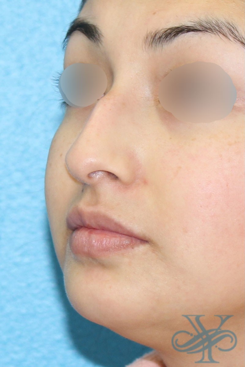 Before filler Dr. Yegiyants, Santa Barbara, CA