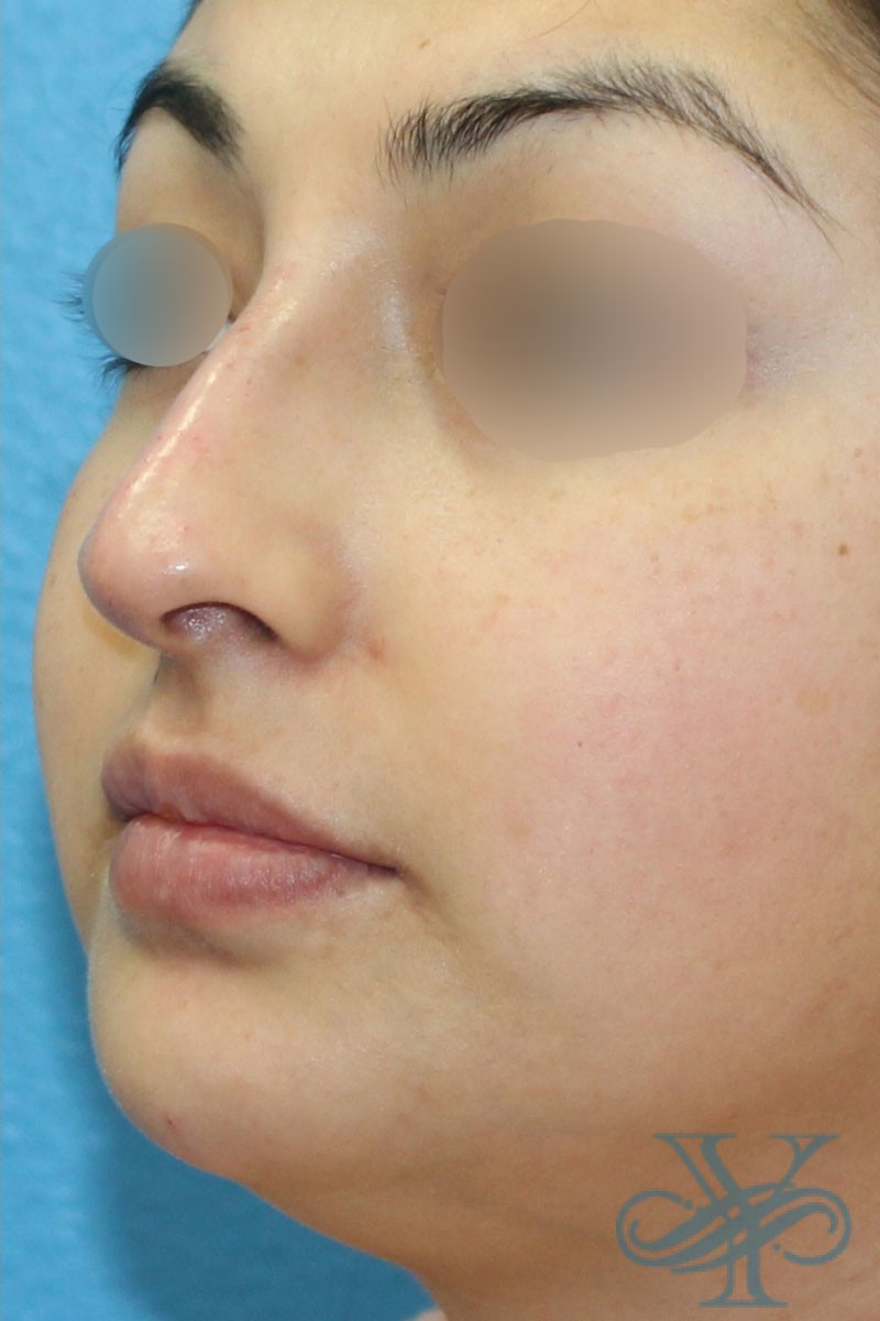 After filler Dr. Yegiyants, Santa Barbara, CA