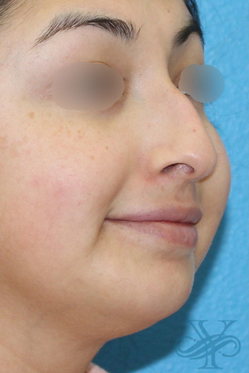 Before filler Dr. Yegiyants, Santa Barbara, CA