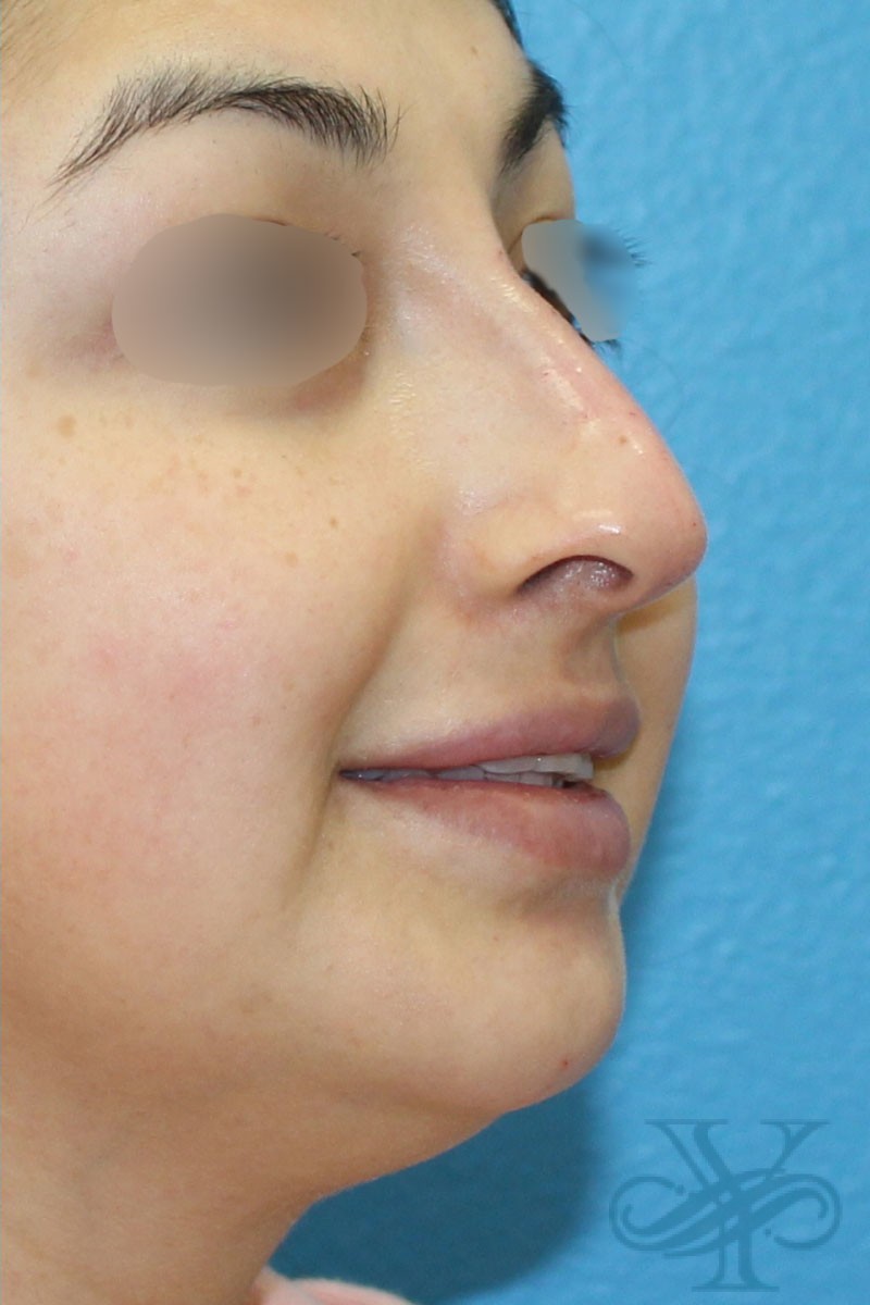 After filler Dr. Yegiyants, Santa Barbara, CA