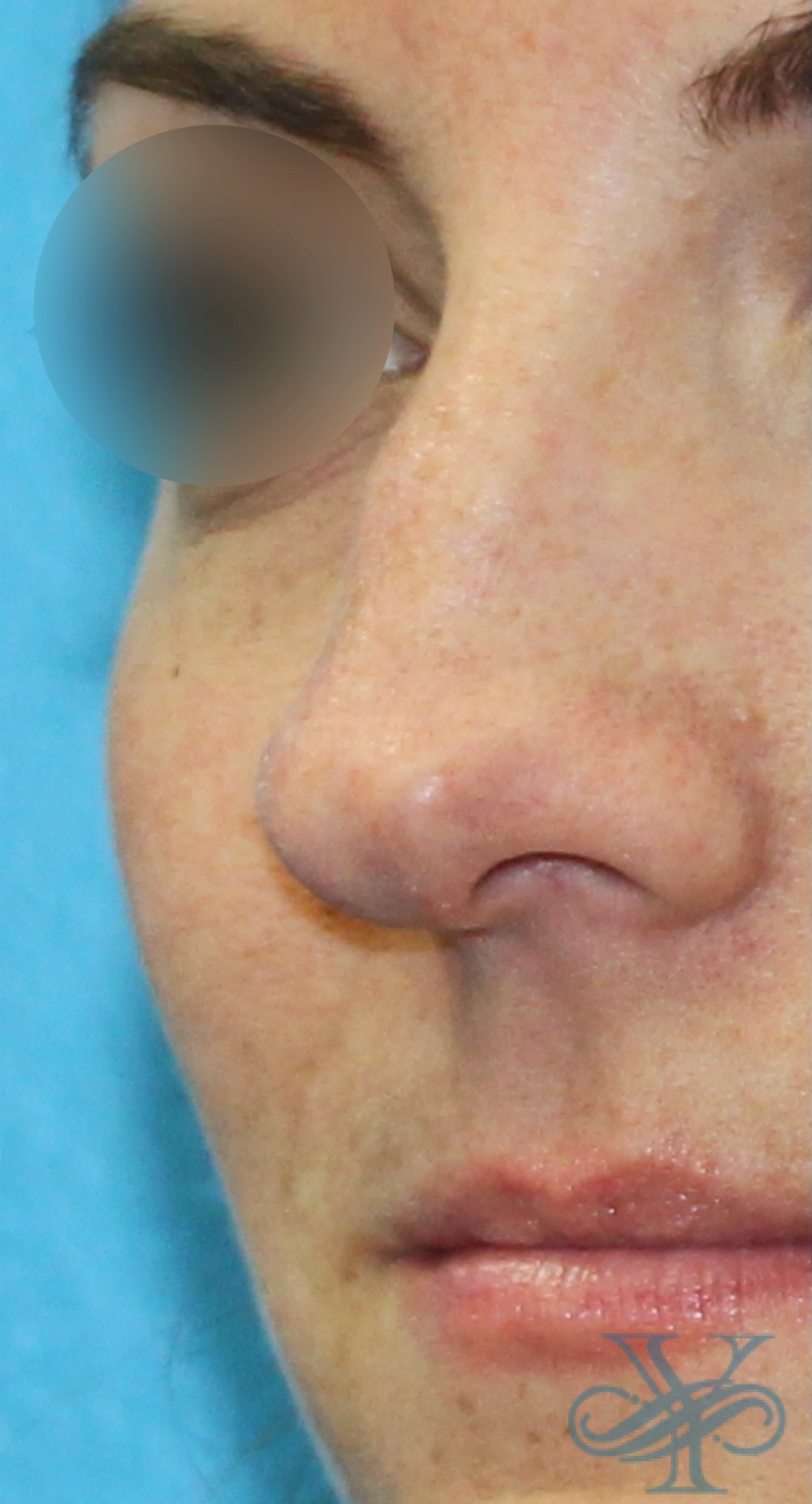 Before filler Dr. Yegiyants, Santa Barbara, CA