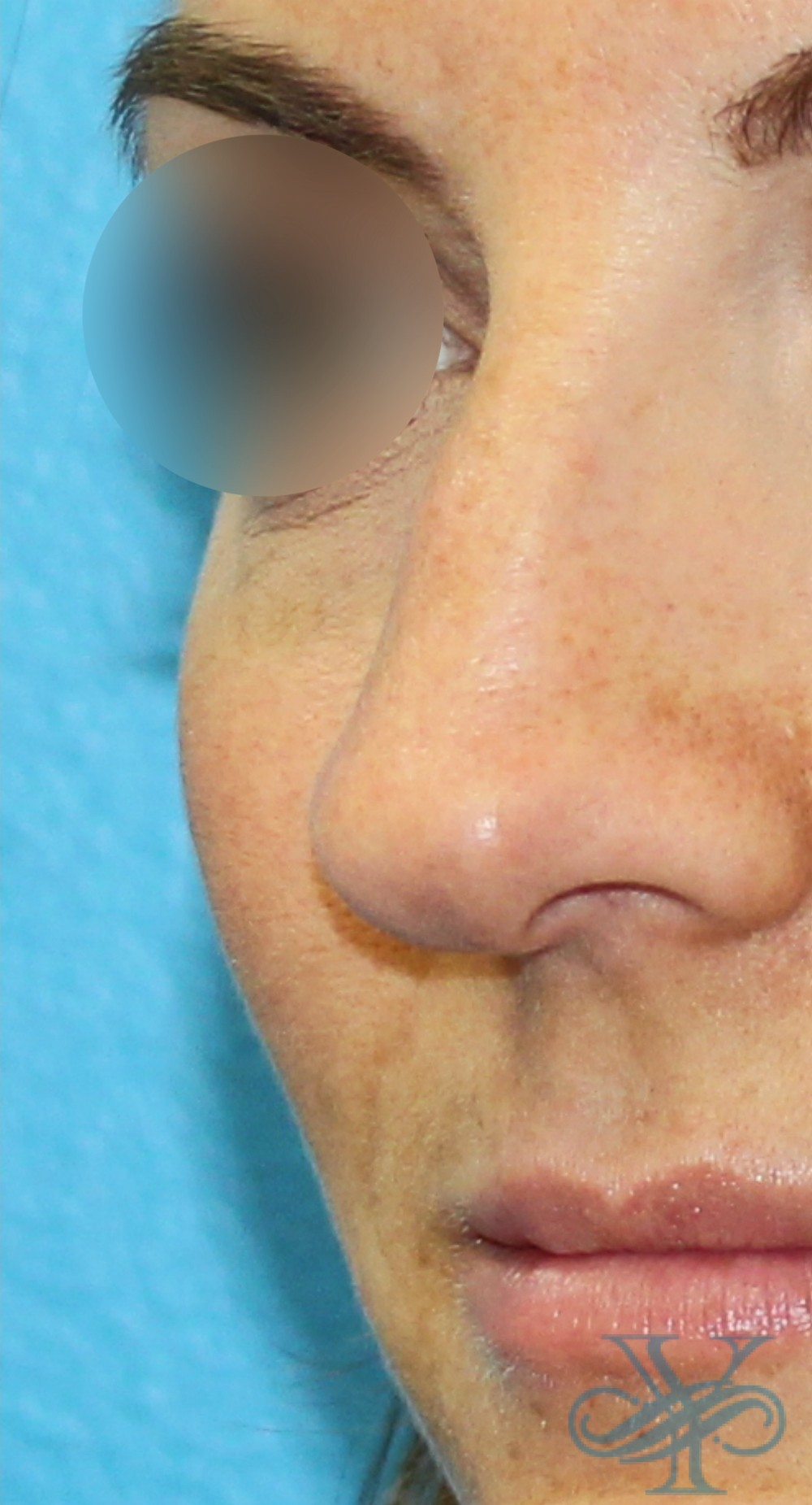 After filler Dr. Yegiyants, Santa Barbara, CA