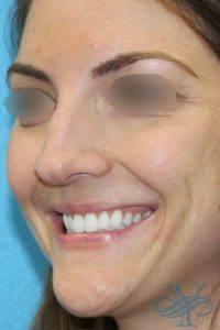 Before filler Dr. Yegiyants, Santa Barbara, CA