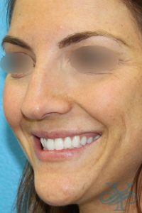 After filler Dr. Yegiyants, Santa Barbara, CA