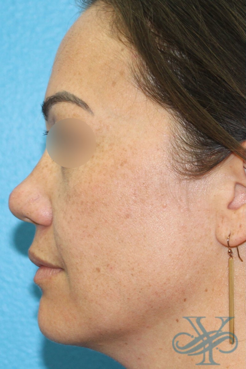 Before laser treatment Dr. Yegiyants, Santa Barbara, CA
