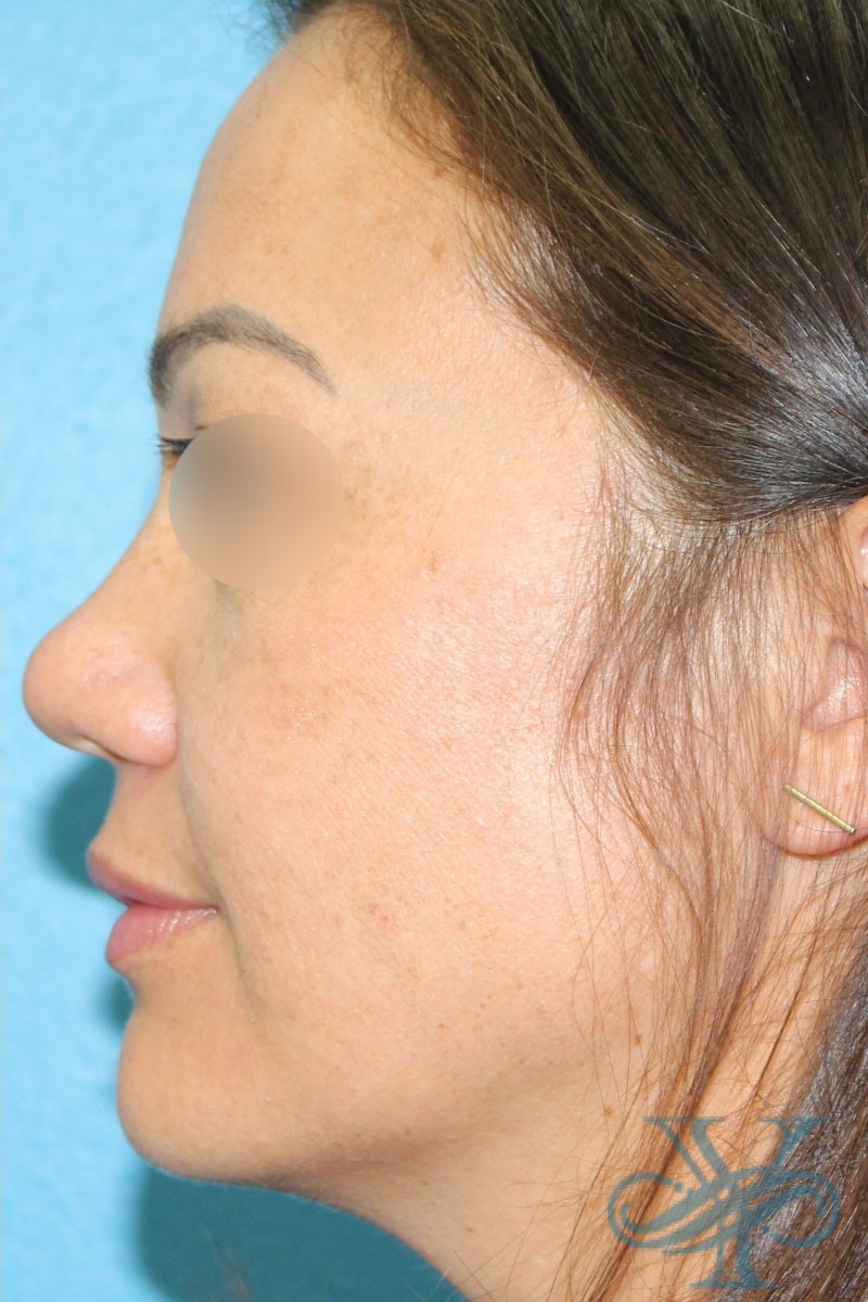After laser treatment Dr. Yegiyants, Santa Barbara, CA