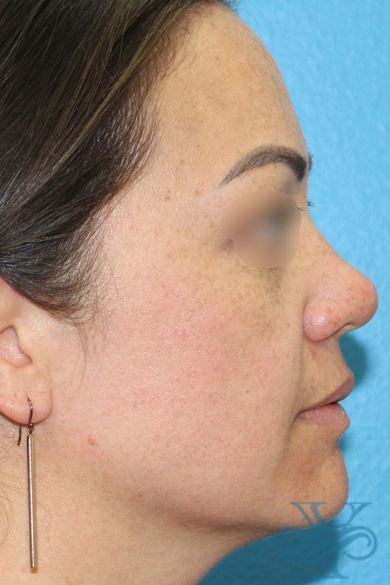 Before laser treatment Dr. Yegiyants, Santa Barbara, CA
