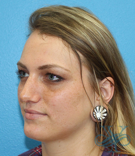 After rhinoplasty Dr. Yegiyants, Santa Barbara, CA