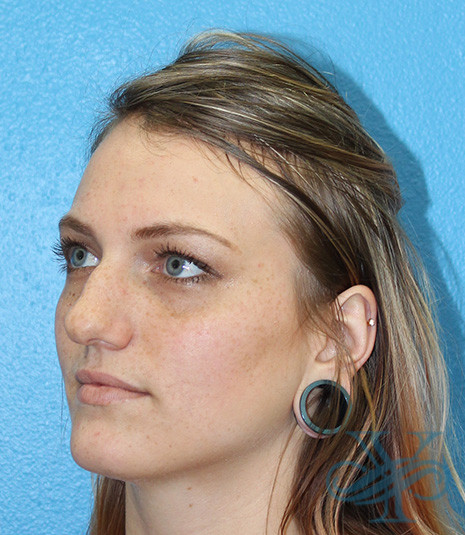 Before rhinoplasty Dr. Yegiyants, Santa Barbara, CA