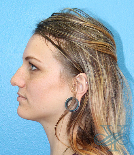 Before rhinoplasty Dr. Yegiyants, Santa Barbara, CA