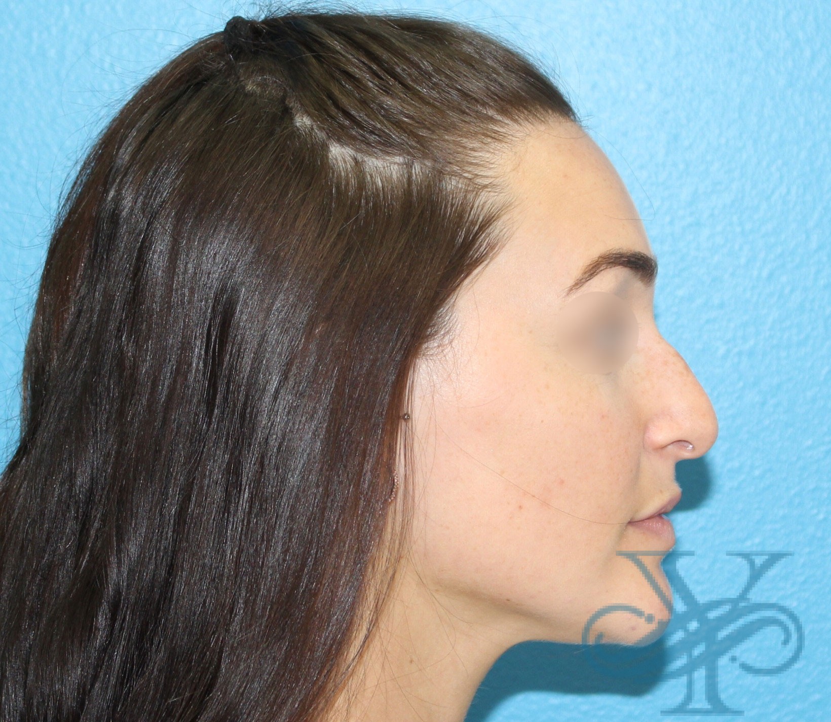 Before rhinoplasty Dr. Yegiyants, Santa Barbara, CA