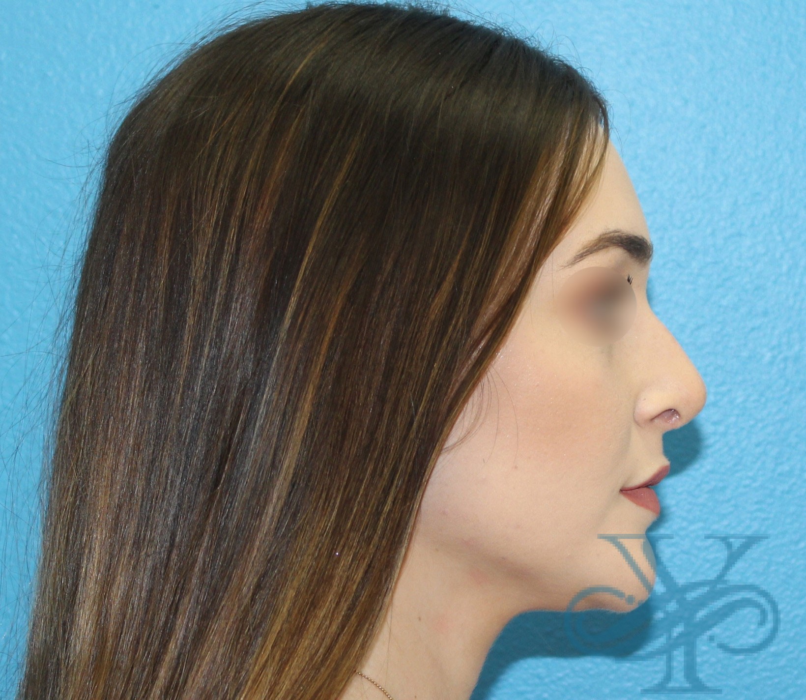 After rhinoplasty Dr. Yegiyants, Santa Barbara, CA