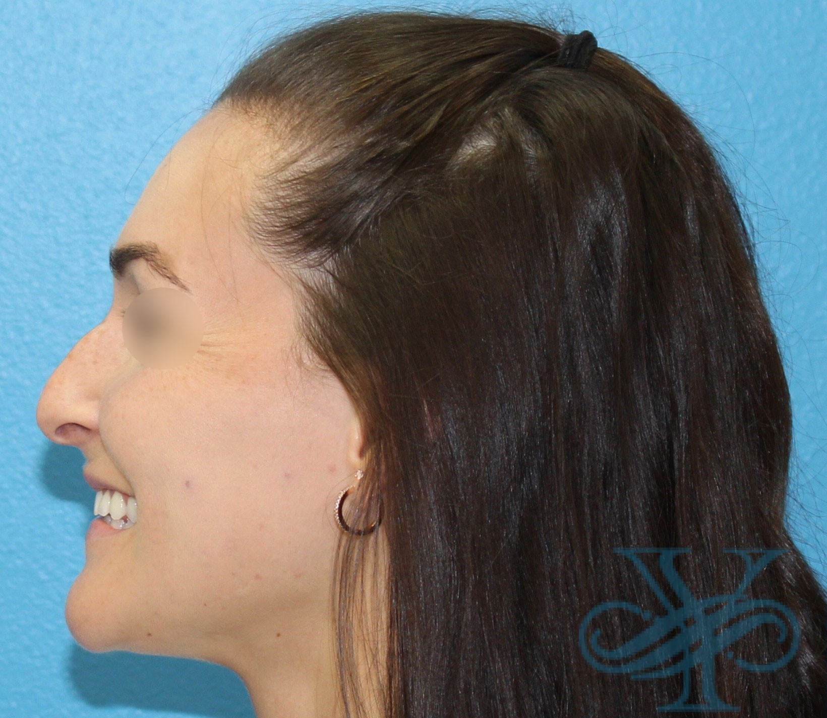 Before rhinoplasty Dr. Yegiyants, Santa Barbara, CA