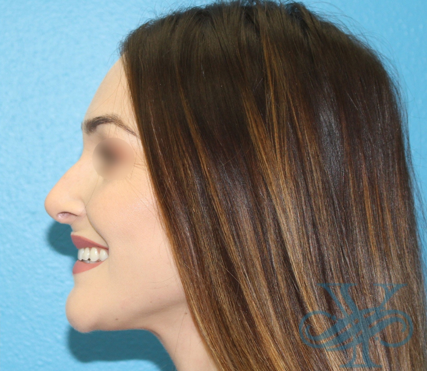 After rhinoplasty Dr. Yegiyants, Santa Barbara, CA