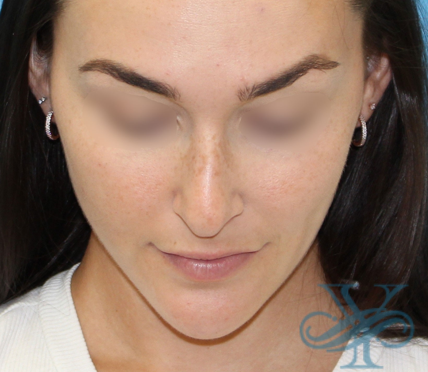 After rhinoplasty Dr. Yegiyants, Santa Barbara, CA