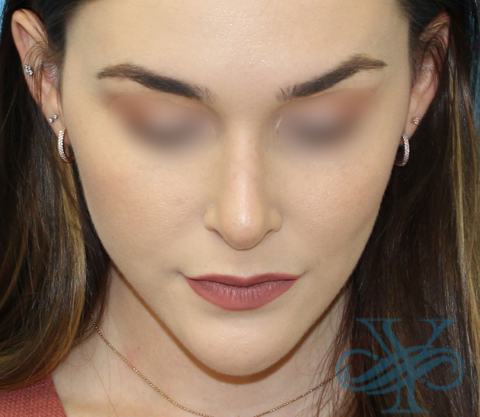 After rhinoplasty Dr. Yegiyants, Santa Barbara, CA