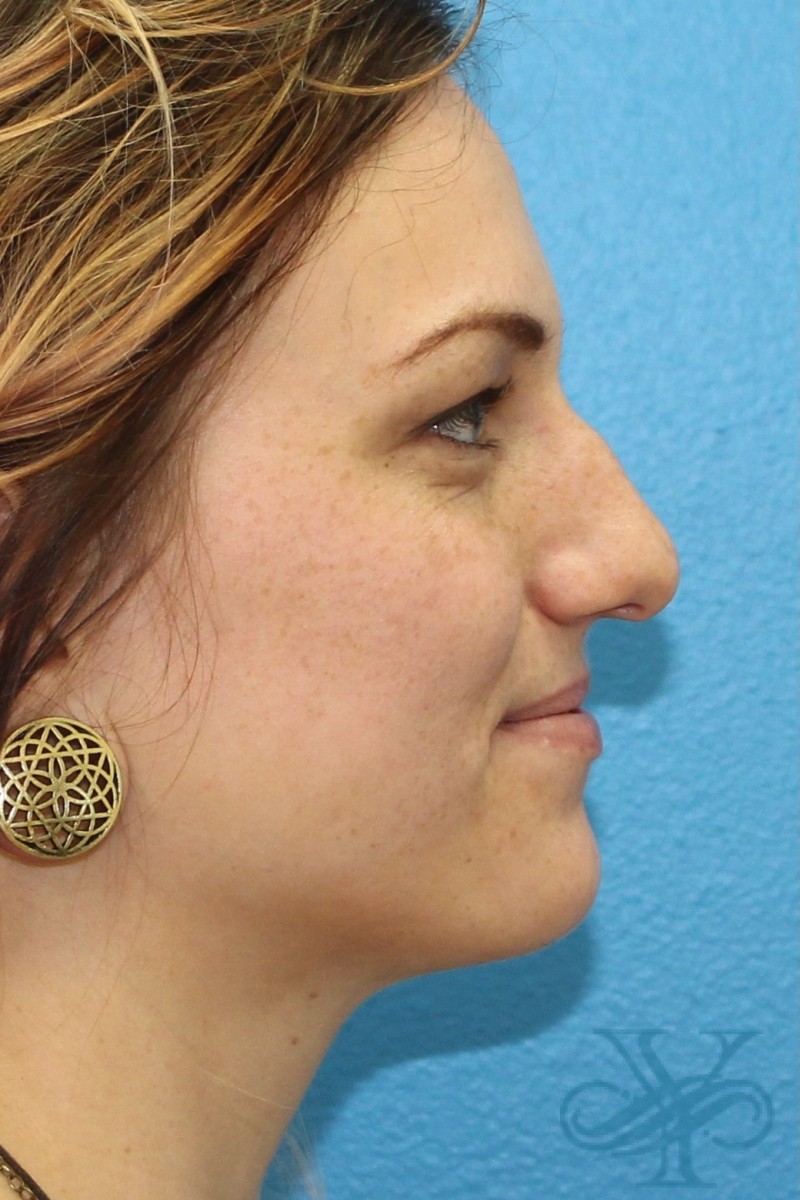 Before rhinoplasty Dr. Yegiyants, Santa Barbara, CA