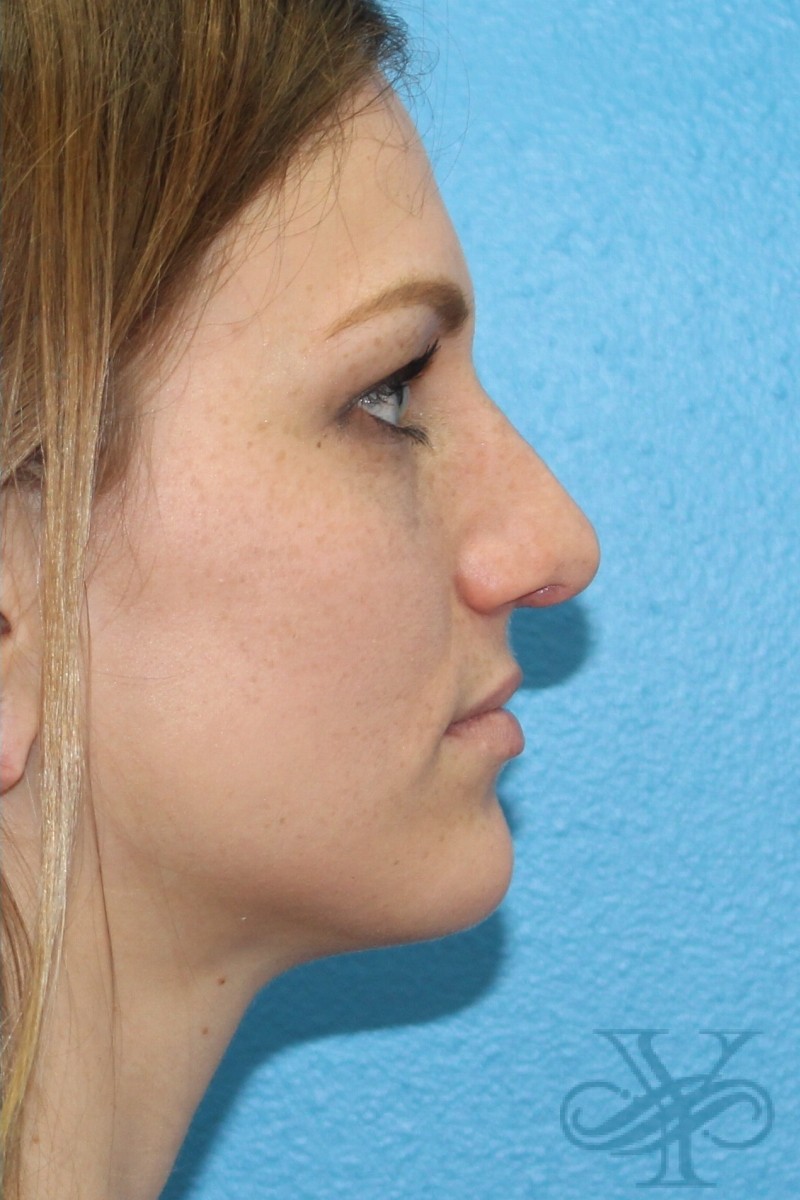 After rhinoplasty Dr. Yegiyants, Santa Barbara, CA