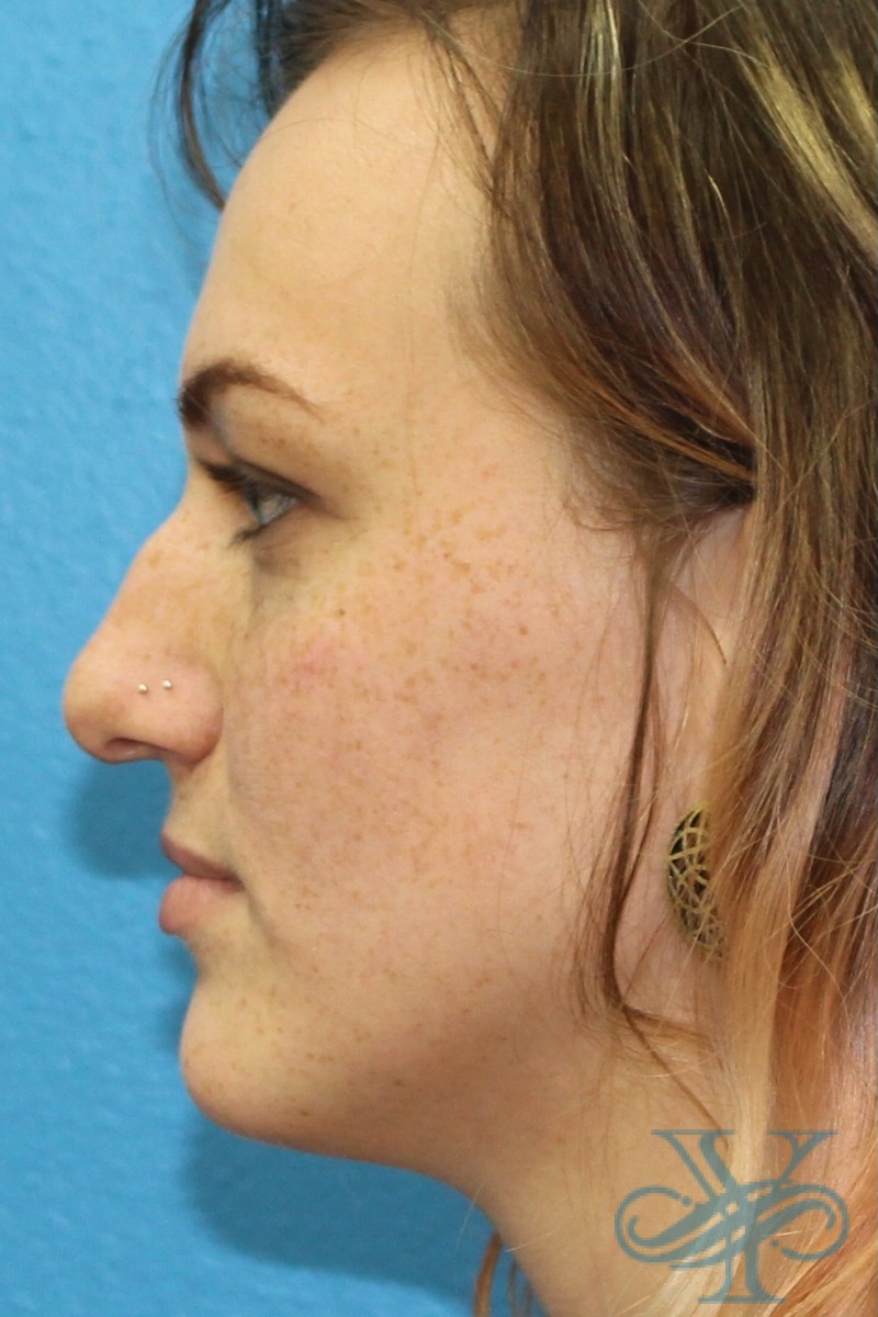 Before rhinoplasty Dr. Yegiyants, Santa Barbara, CA