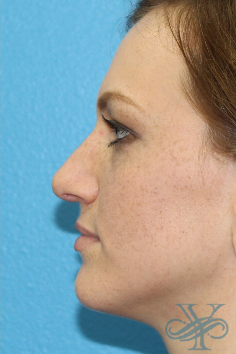 After rhinoplasty Dr. Yegiyants, Santa Barbara, CA