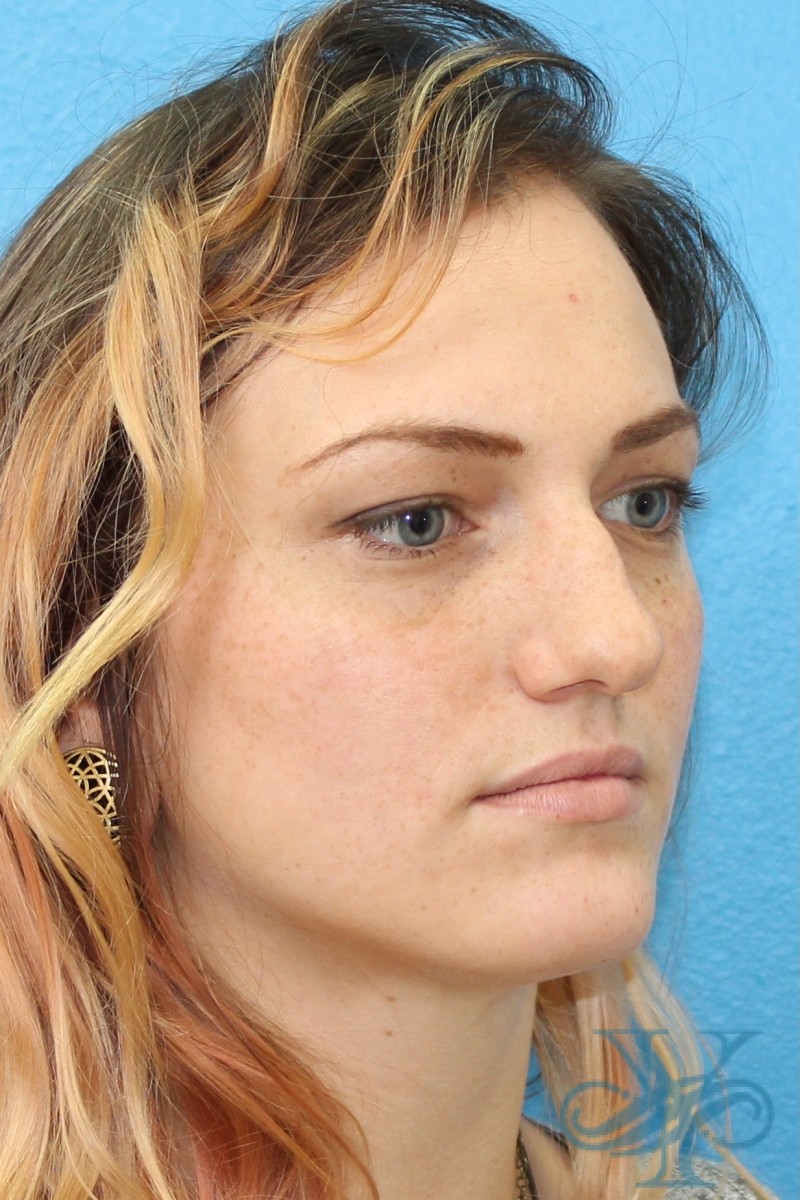 Before rhinoplasty Dr. Yegiyants, Santa Barbara, CA