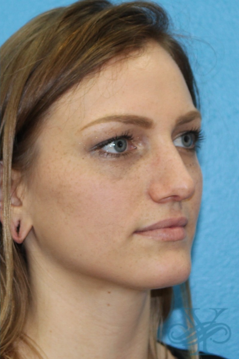 After rhinoplasty Dr. Yegiyants, Santa Barbara, CA