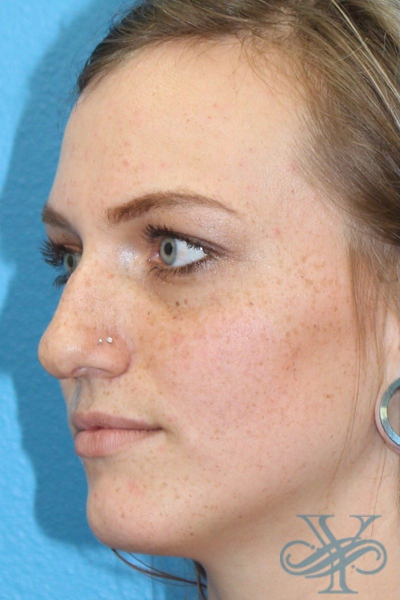 Before rhinoplasty Dr. Yegiyants, Santa Barbara, CA