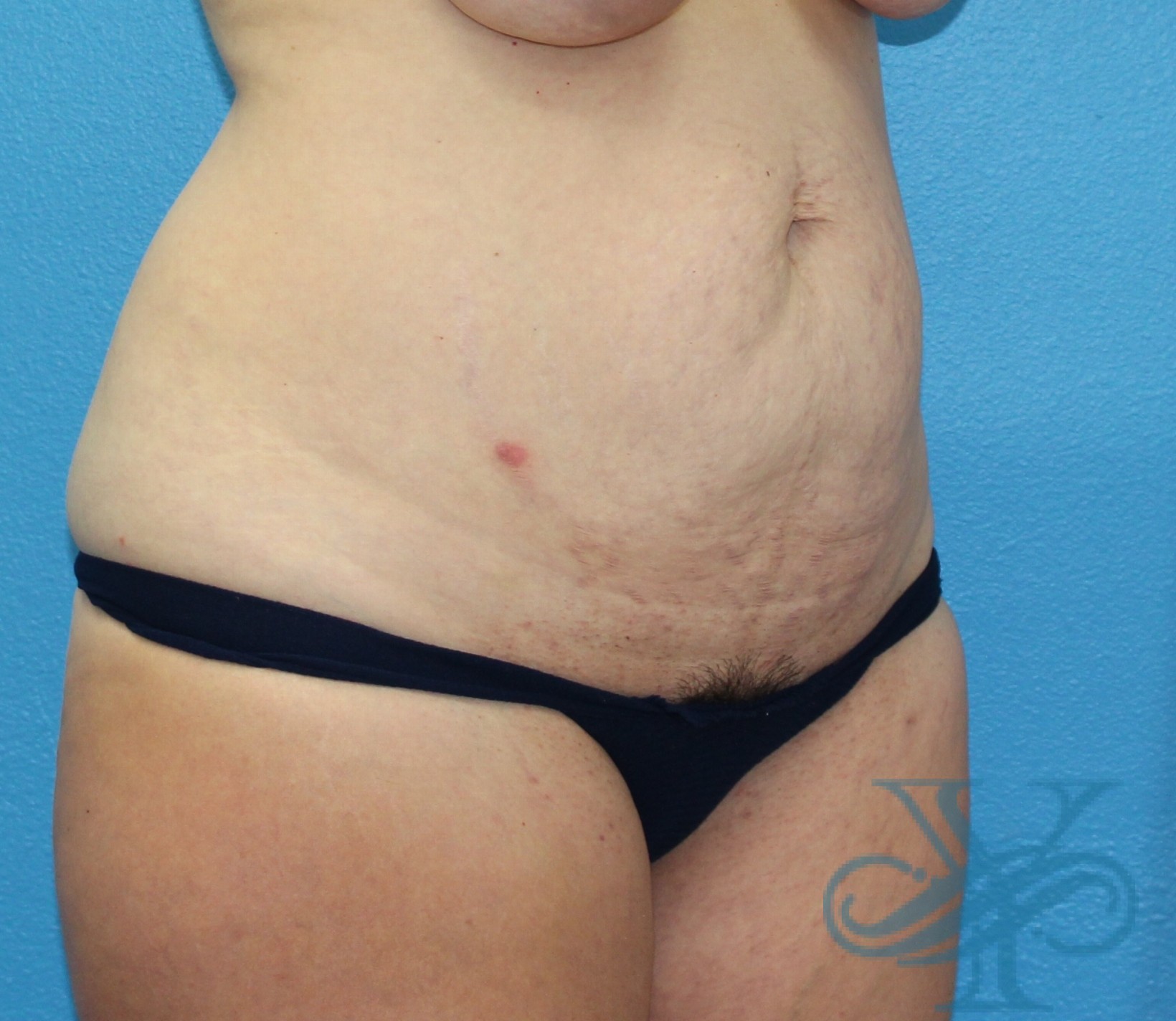 Before abdominoplasty Dr. Yegiyants, Santa Barbara, CA