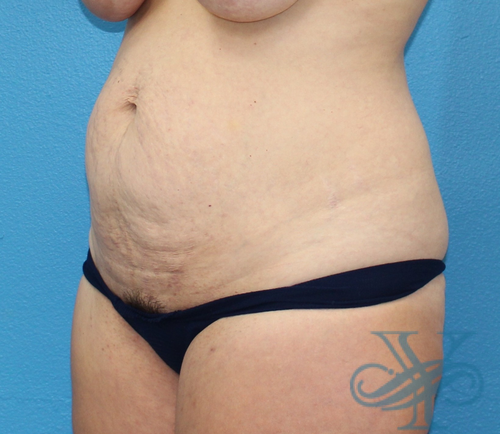 Before abdominoplasty Dr. Yegiyants, Santa Barbara, CA