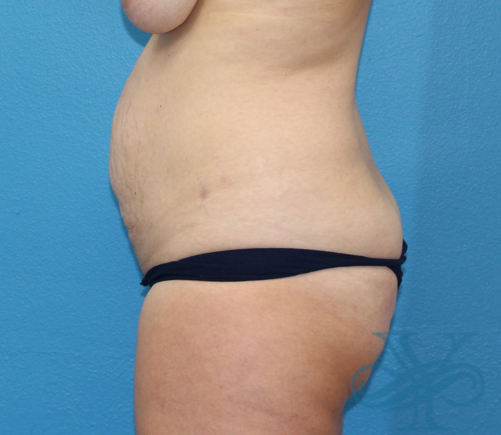 Before abdominoplasty Dr. Yegiyants, Santa Barbara, CA