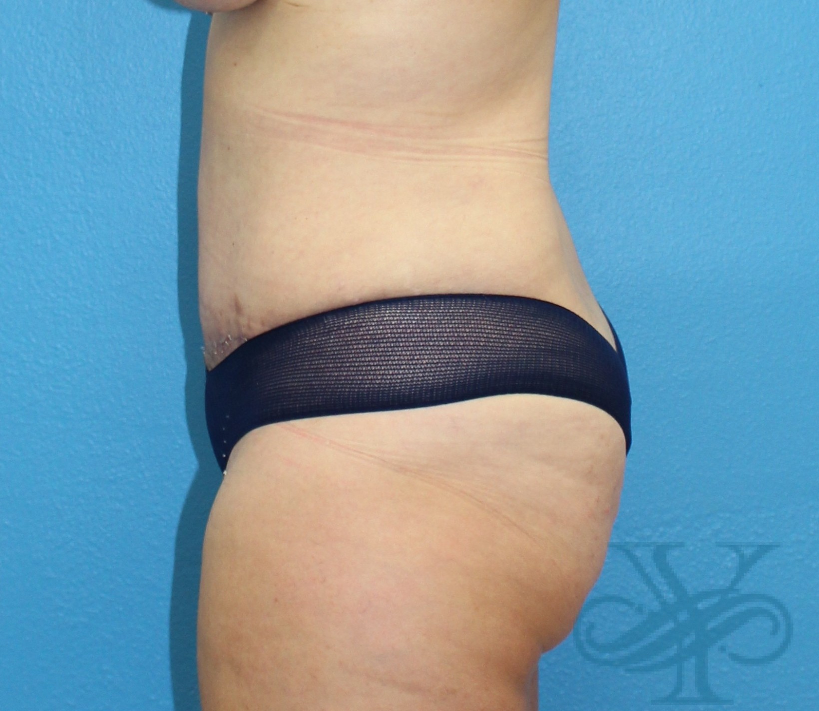 After abdominoplasty Dr. Yegiyants, Santa Barbara, CA