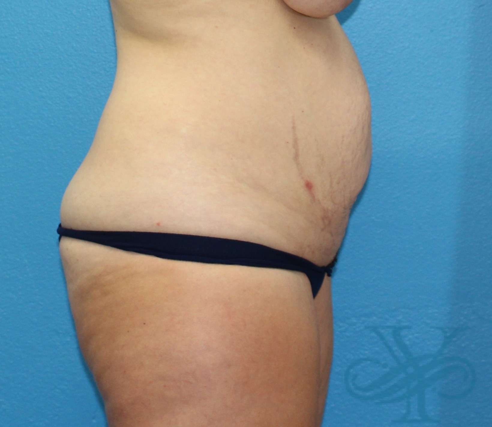 Before abdominoplasty Dr. Yegiyants, Santa Barbara, CA