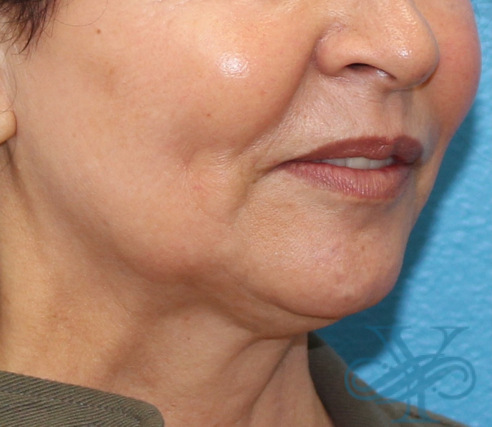 Before Kybella Dr. Yegiyants, Santa Barbara, CA
