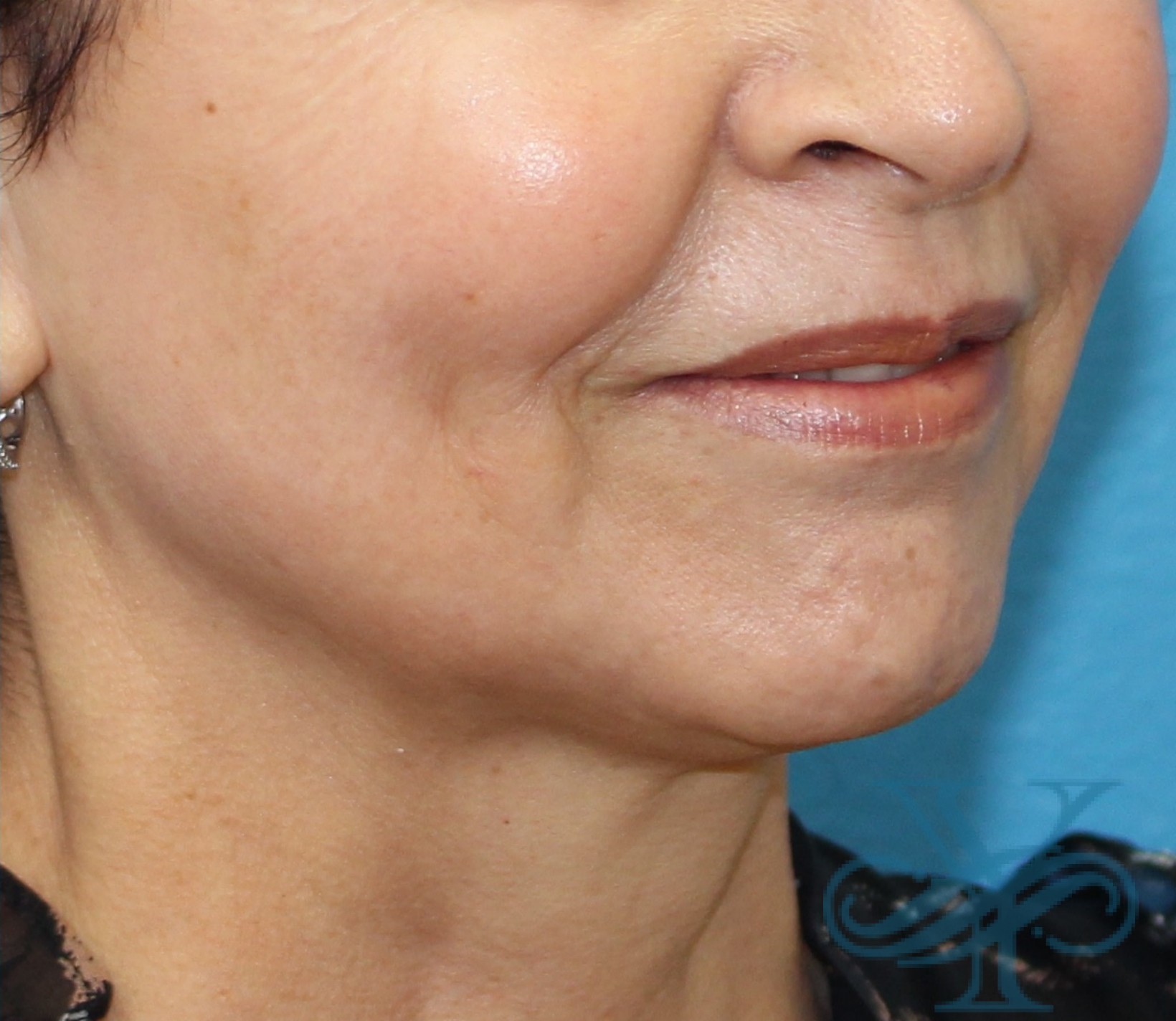 After Kybella Dr. Yegiyants, Santa Barbara, CA