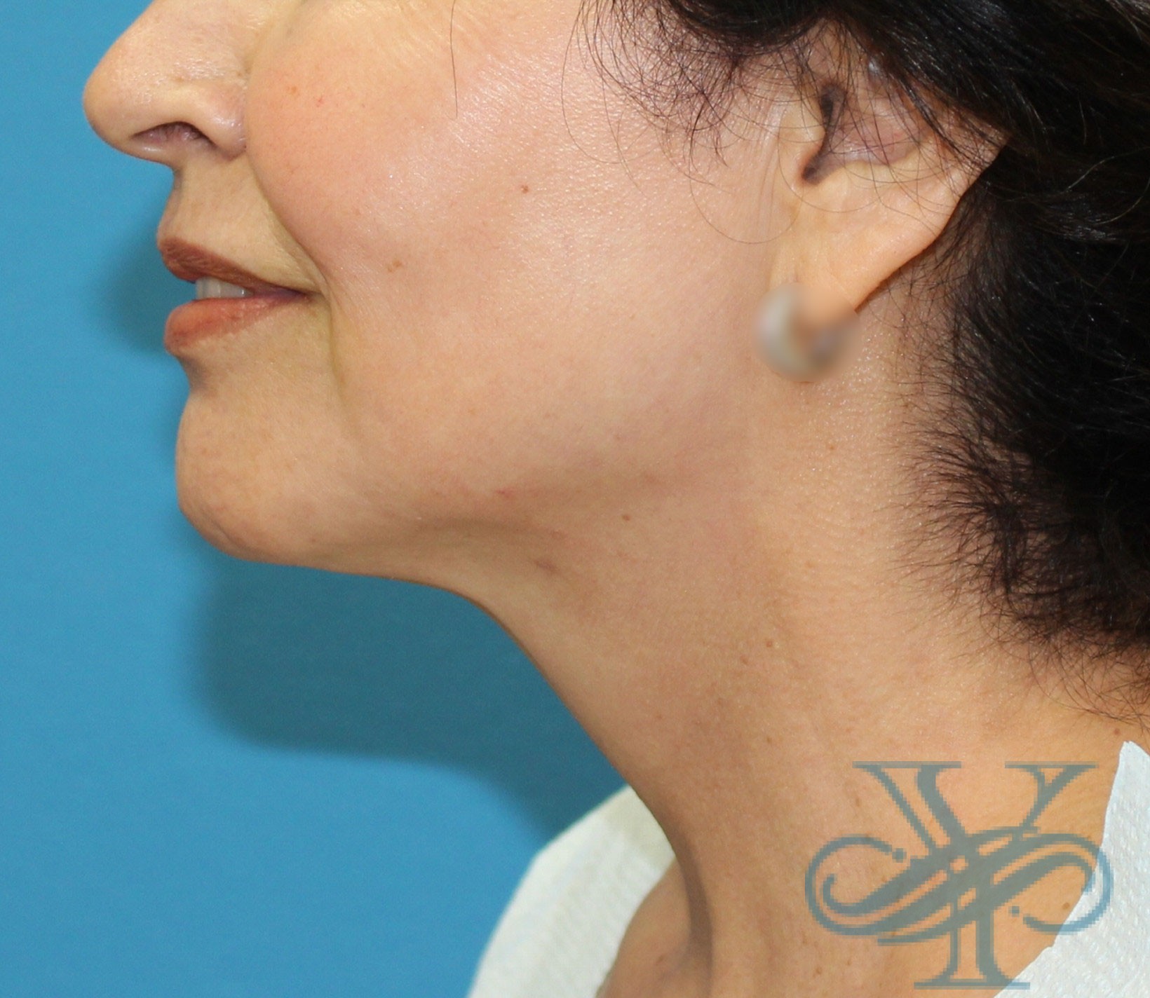After Kybella Dr. Yegiyants, Santa Barbara, CA