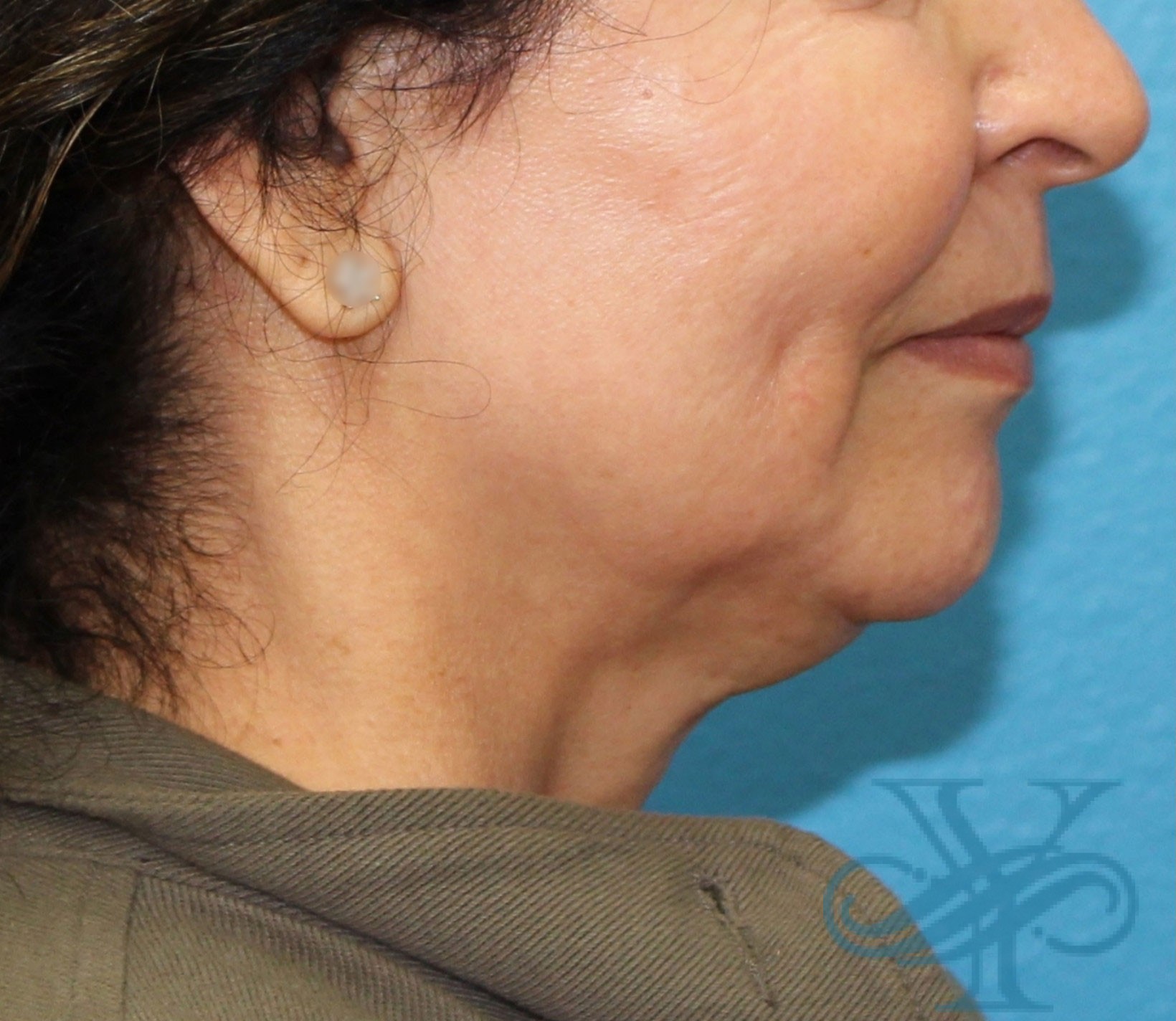 Before Kybella Dr. Yegiyants, Santa Barbara, CA