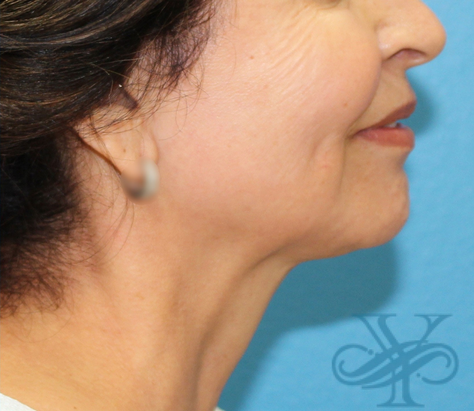 After Kybella Dr. Yegiyants, Santa Barbara, CA