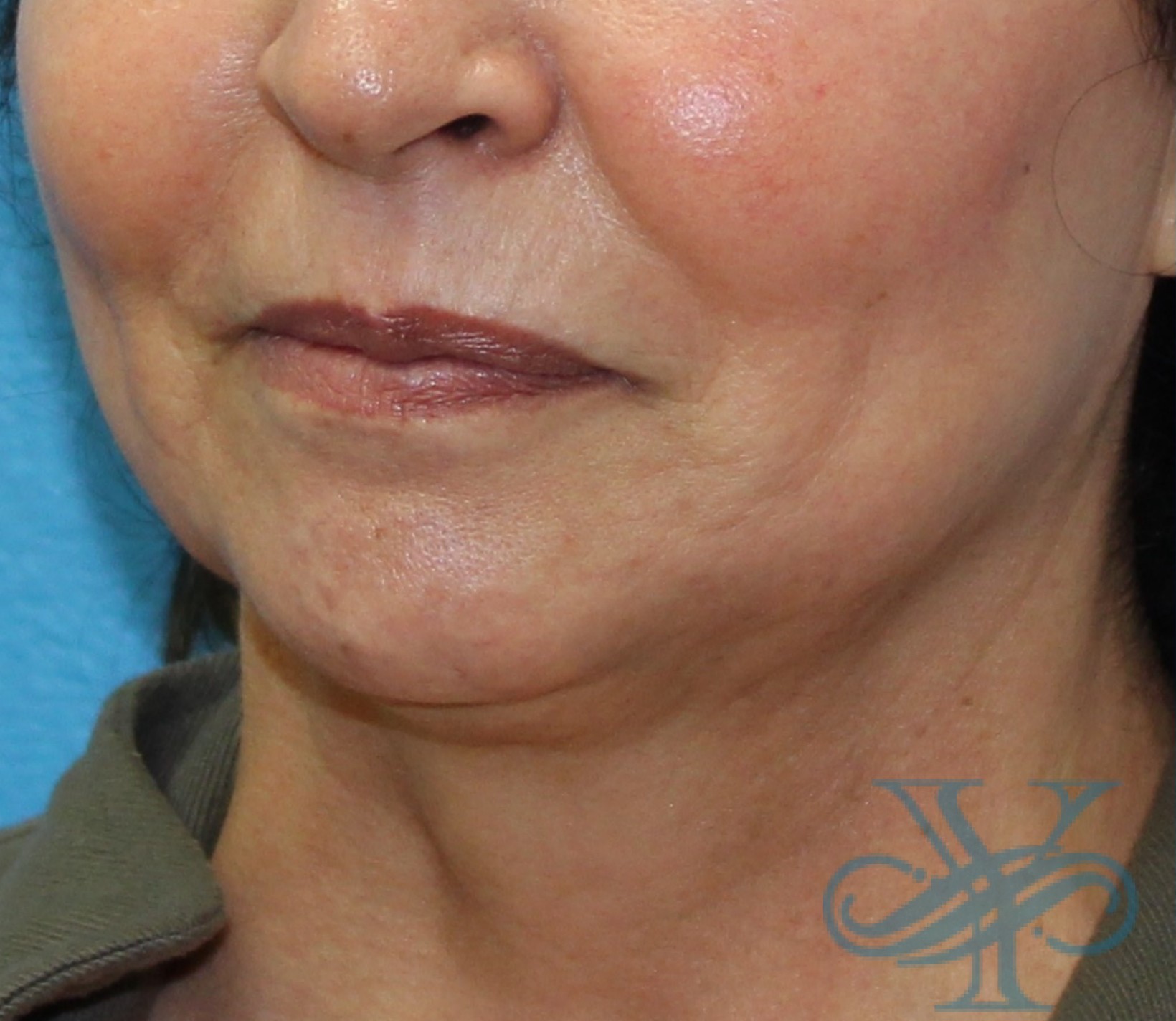 Before Kybella Dr. Yegiyants, Santa Barbara, CA