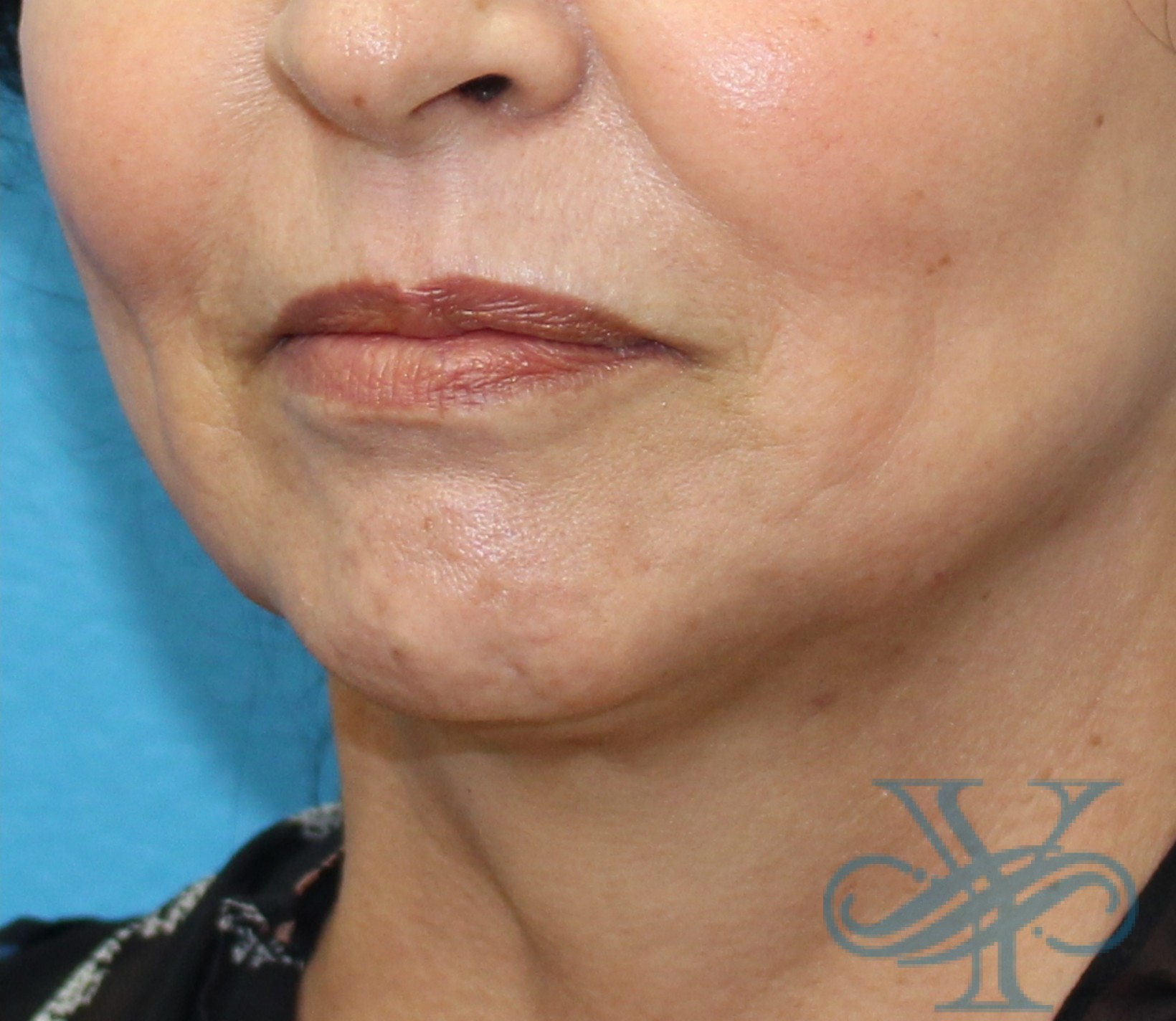 After Kybella Dr. Yegiyants, Santa Barbara, CA